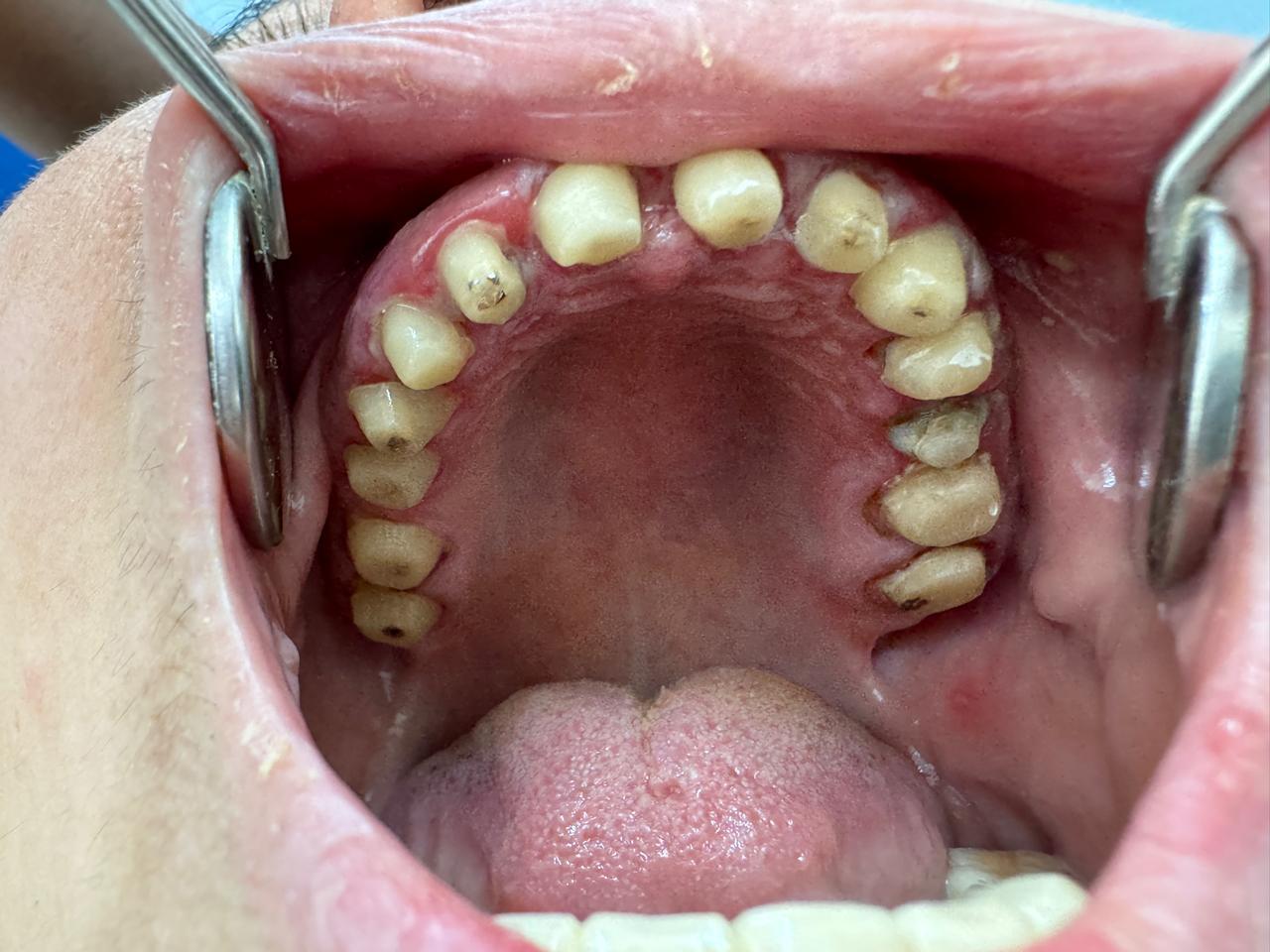 Full mouth rehabilitation: Severely attrited teeth restored with multiple root pins and zirconium crowns treatment